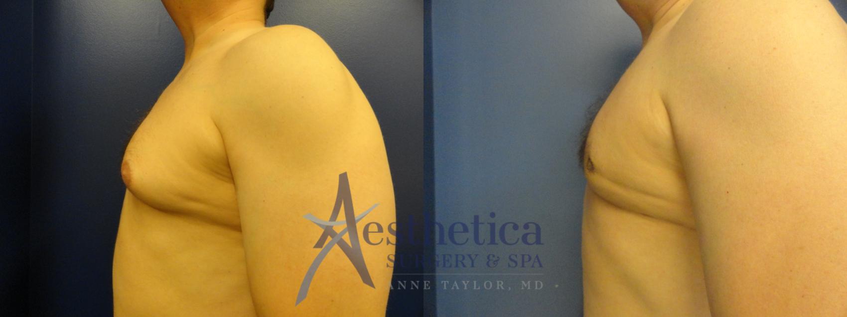Gynecomastia Case 199 Before & After View #3 | Columbus, OH | Aesthetica Surgery & Spa