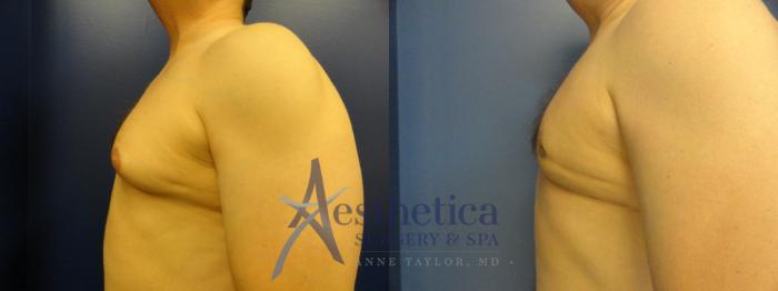 Gynecomastia Case 199 Before & After View #3 | Columbus, OH | Aesthetica Surgery & Spa