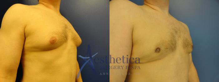 Gynecomastia Case 199 Before & After View #4 | Columbus, OH | Aesthetica Surgery & Spa