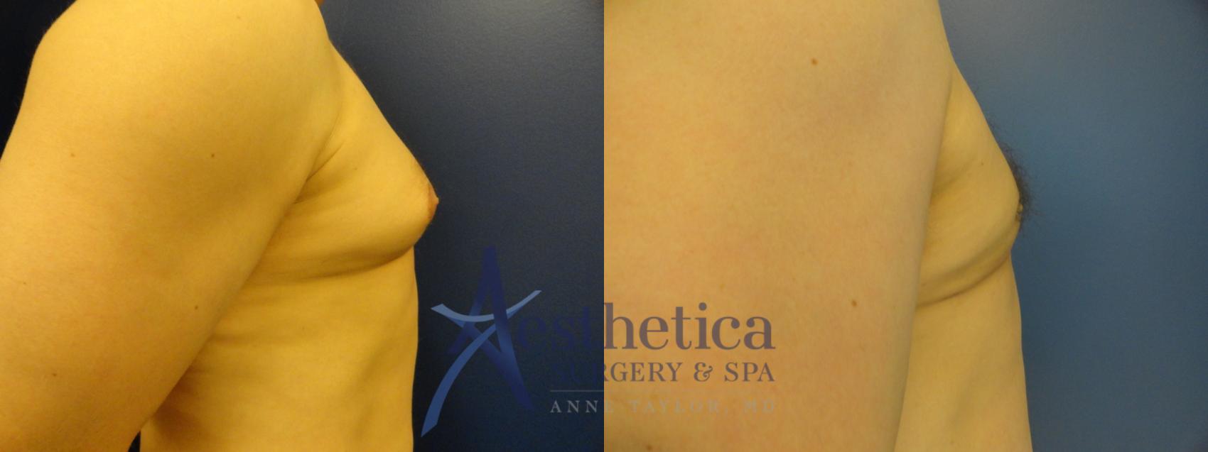 Gynecomastia Case 199 Before & After View #5 | Columbus, OH | Aesthetica Surgery & Spa