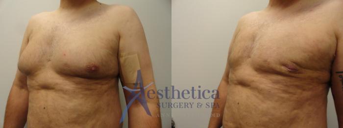 Gynecomastia Case 210 Before & After View #1 | Columbus, OH | Aesthetica Surgery & Spa