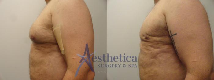Gynecomastia Case 210 Before & After View #2 | Columbus, OH | Aesthetica Surgery & Spa