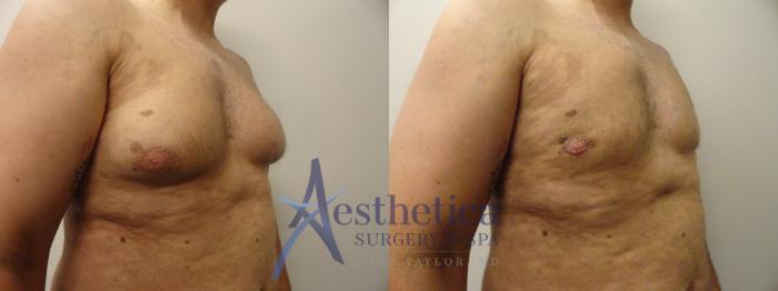 Gynecomastia Case 210 Before & After View #3 | Columbus, OH | Aesthetica Surgery & Spa