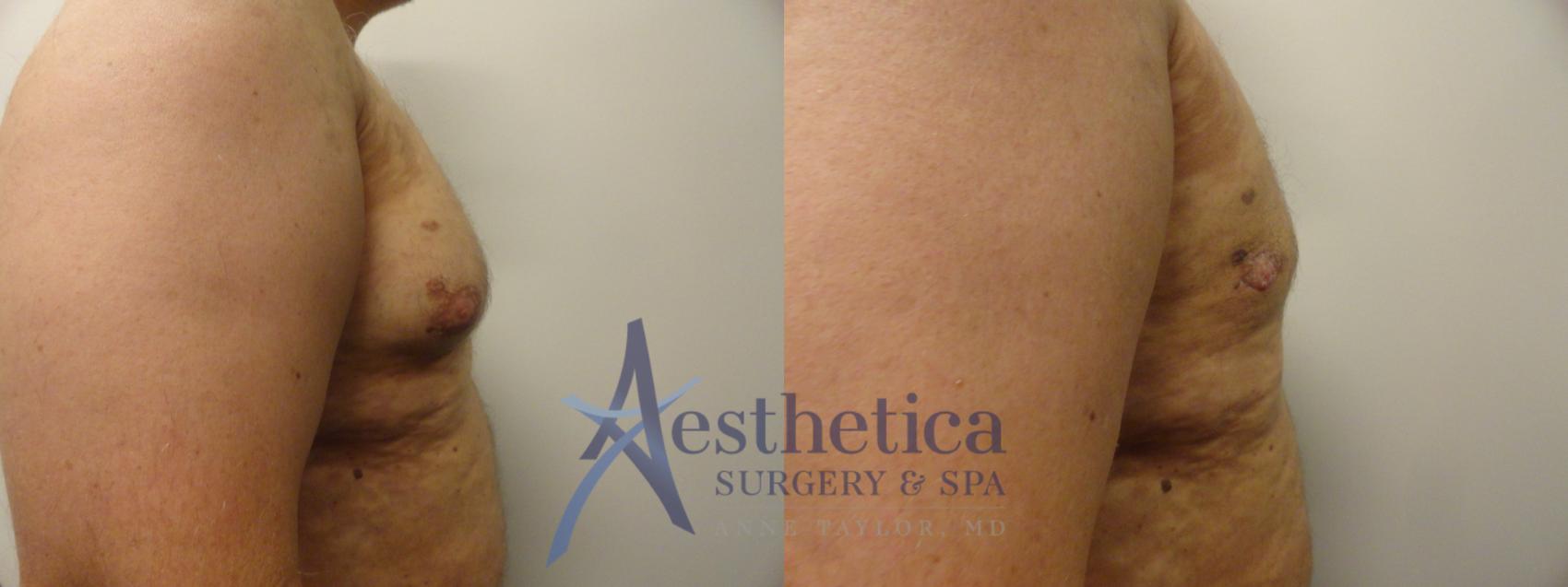 Gynecomastia Case 210 Before & After View #4 | Columbus, OH | Aesthetica Surgery & Spa