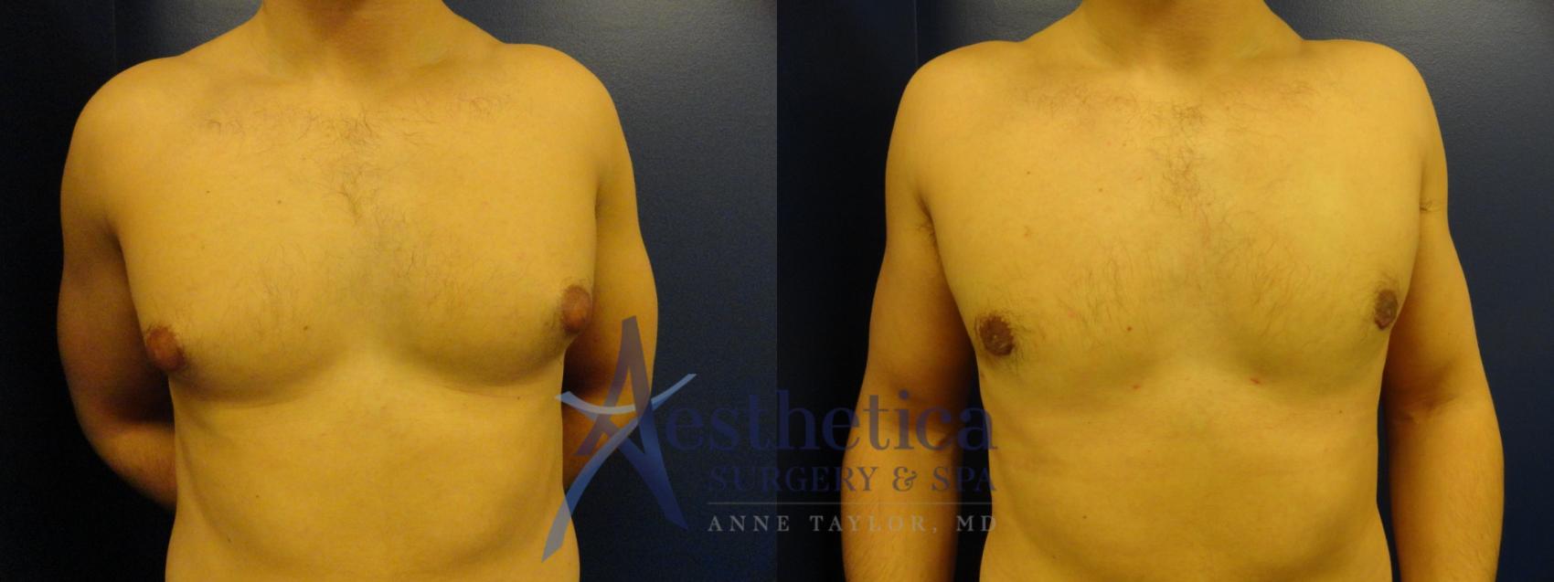 Gynecomastia Case 343 Before & After View #1 | Columbus, OH | Aesthetica Surgery & Spa