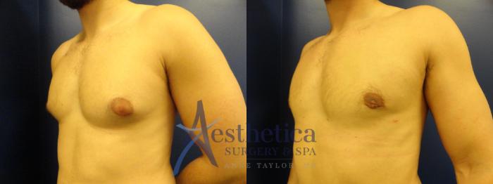 Gynecomastia Case 343 Before & After View #2 | Columbus, OH | Aesthetica Surgery & Spa