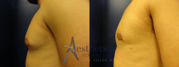 Gynecomastia Case 343 Before & After View #3 | Columbus, OH | Aesthetica Surgery & Spa