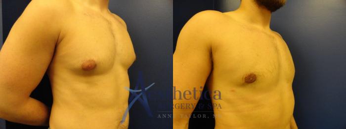 Gynecomastia Case 343 Before & After View #4 | Columbus, OH | Aesthetica Surgery & Spa