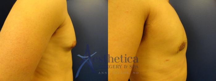 Gynecomastia Case 343 Before & After View #5 | Columbus, OH | Aesthetica Surgery & Spa