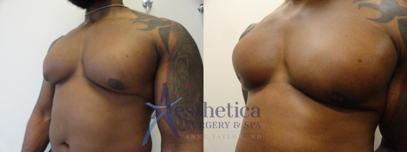 Gynecomastia Case 344 Before & After View #2 | Columbus, OH | Aesthetica Surgery & Spa