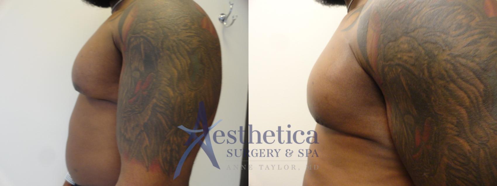 Gynecomastia Case 344 Before & After View #3 | Columbus, OH | Aesthetica Surgery & Spa