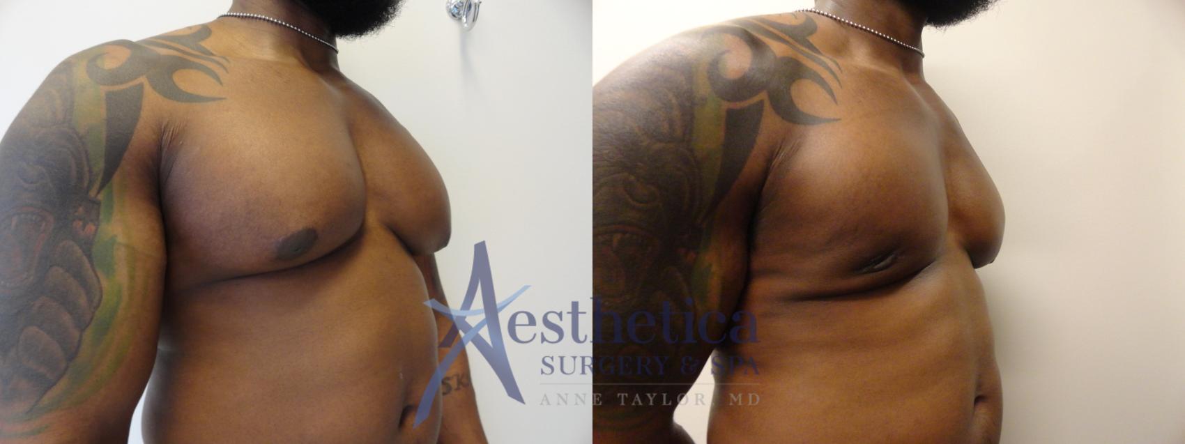 Gynecomastia Case 344 Before & After View #4 | Columbus, OH | Aesthetica Surgery & Spa