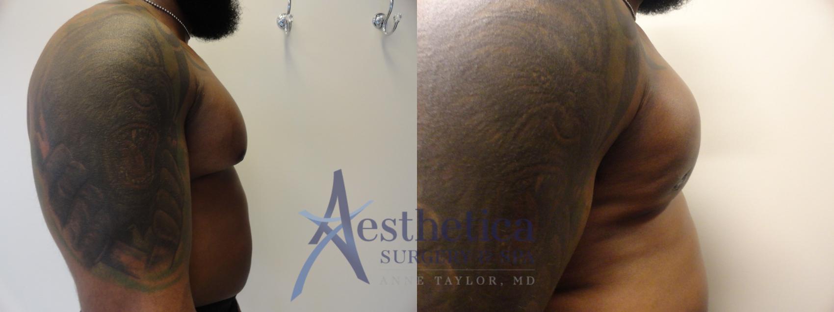 Gynecomastia Case 344 Before & After View #5 | Columbus, OH | Aesthetica Surgery & Spa