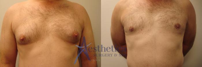 Gynecomastia Case 360 Before & After View #1 | Columbus, OH | Aesthetica Surgery & Spa