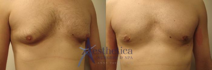 Gynecomastia Case 429 Before & After View #1 | Columbus, OH | Aesthetica Surgery & Spa