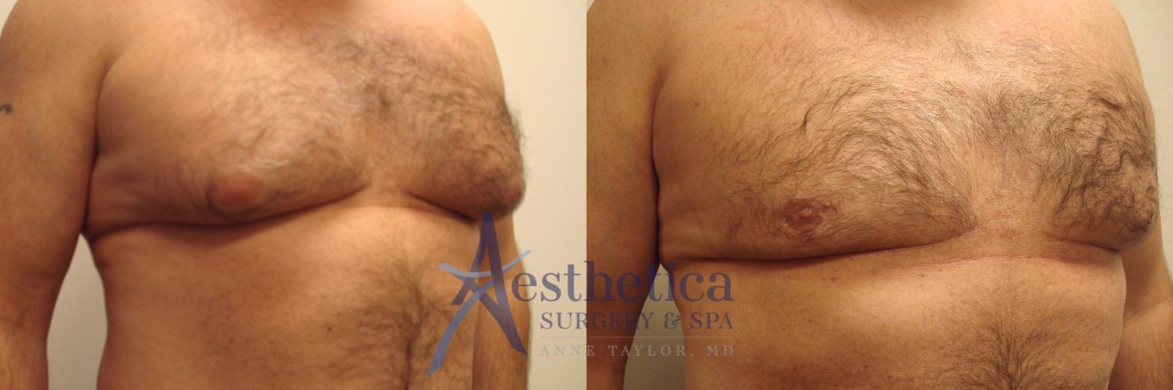 Gynecomastia Case 440 Before & After Front | Worthington, OH | Aesthetica Surgery & Spa