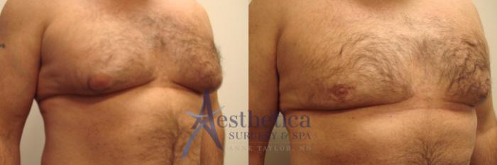 Gynecomastia Case 440 Before & After Front | Columbus, OH | Aesthetica Surgery & Spa