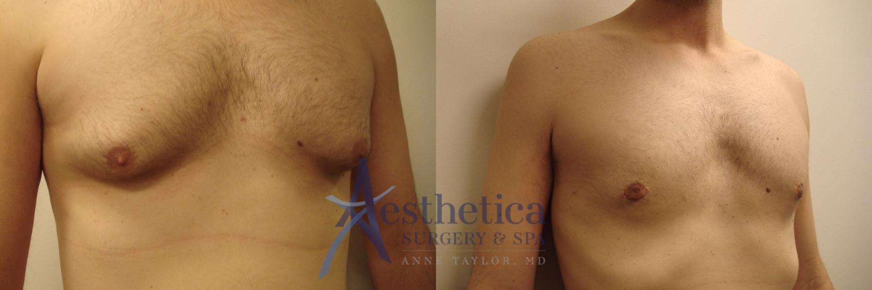 Gynecomastia Case 445 Before & After Front | Worthington, OH | Aesthetica Surgery & Spa