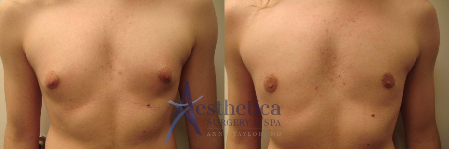 Gynecomastia Case 470 Before & After Front | Columbus, OH | Aesthetica Surgery & Spa