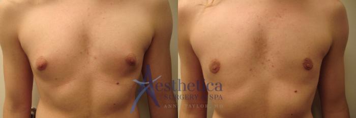 Gynecomastia Case 470 Before & After Front | Columbus, OH | Aesthetica Surgery & Spa