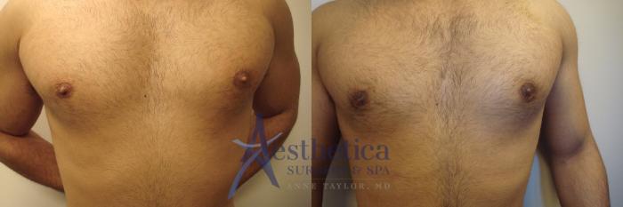 Gynecomastia Case 473 Before & After Front | Columbus, OH | Aesthetica Surgery & Spa