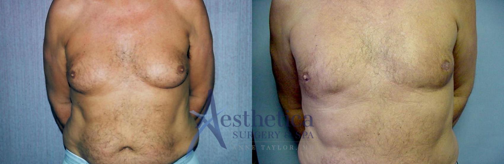 Gynecomastia Case 52 Before & After View #1 | Columbus, OH | Aesthetica Surgery & Spa