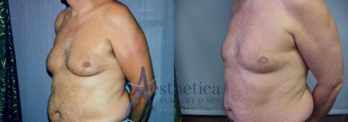 Gynecomastia Case 52 Before & After View #2 | Columbus, OH | Aesthetica Surgery & Spa