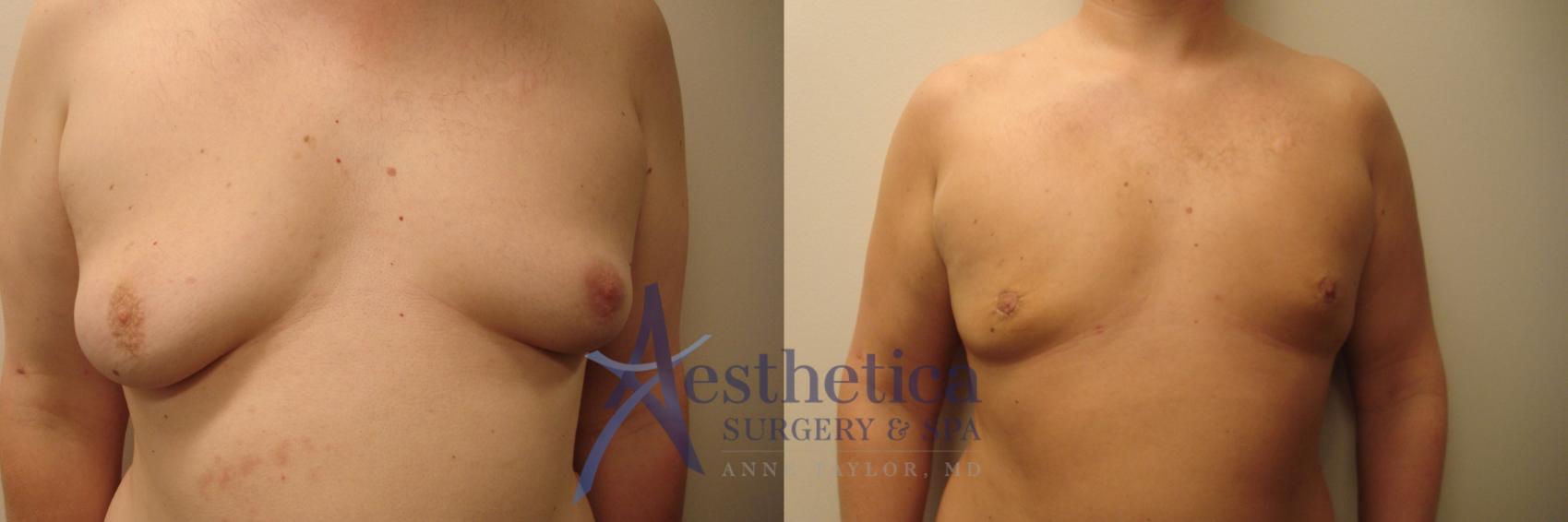 Gynecomastia Case 527 Before & After Front | Worthington, OH | Aesthetica Surgery & Spa