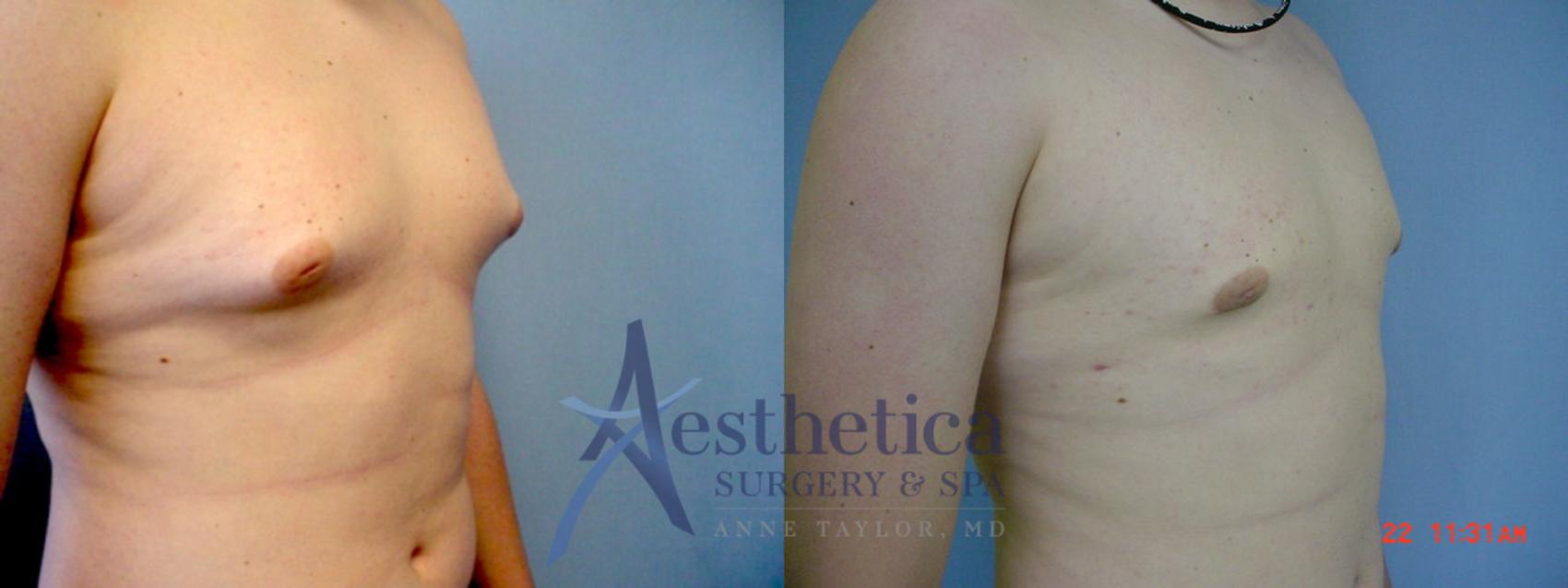Gynecomastia Case 53 Before & After View #1 | Worthington, OH | Aesthetica Surgery & Spa