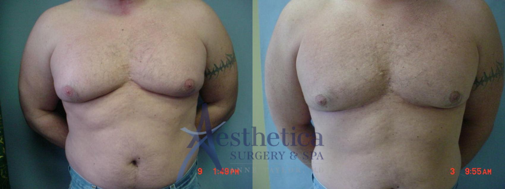 Gynecomastia Case 54 Before & After View #1 | Worthington, OH | Aesthetica Surgery & Spa