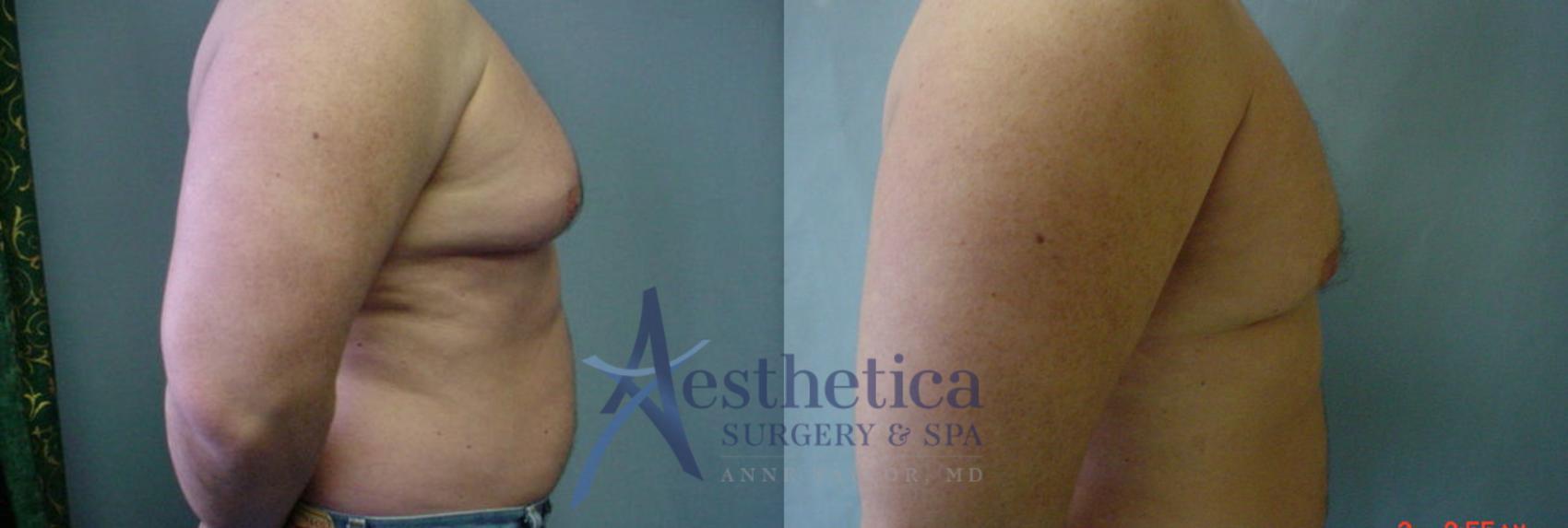 Gynecomastia Case 54 Before & After View #2 | Worthington, OH | Aesthetica Surgery & Spa