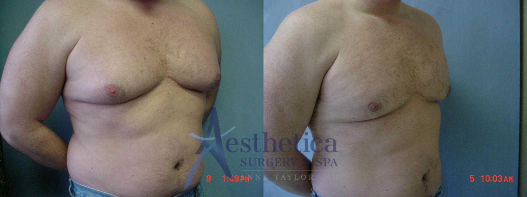 Gynecomastia Case 54 Before & After View #3 | Worthington, OH | Aesthetica Surgery & Spa