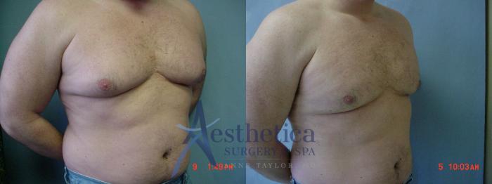 Gynecomastia Case 54 Before & After View #3 | Columbus, OH | Aesthetica Surgery & Spa