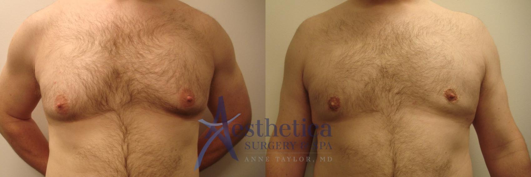 Gynecomastia Case 548 Before & After Front | Columbus, OH | Aesthetica Surgery & Spa