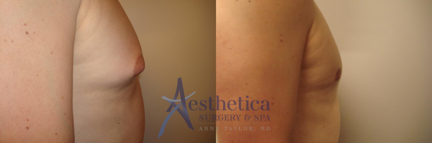 Gynecomastia Case 552 Before & After Front | Worthington, OH | Aesthetica Surgery & Spa