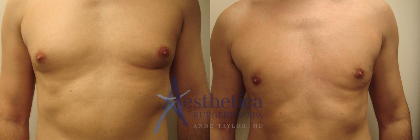 Gynecomastia Case 599 Before & After Front | Worthington, OH | Aesthetica Surgery & Spa
