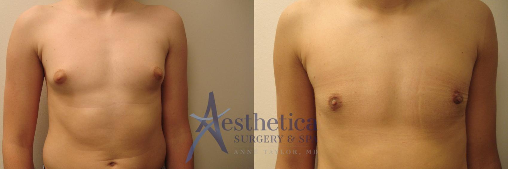Gynecomastia Case 621 Before & After Front | Worthington, OH | Aesthetica Surgery & Spa