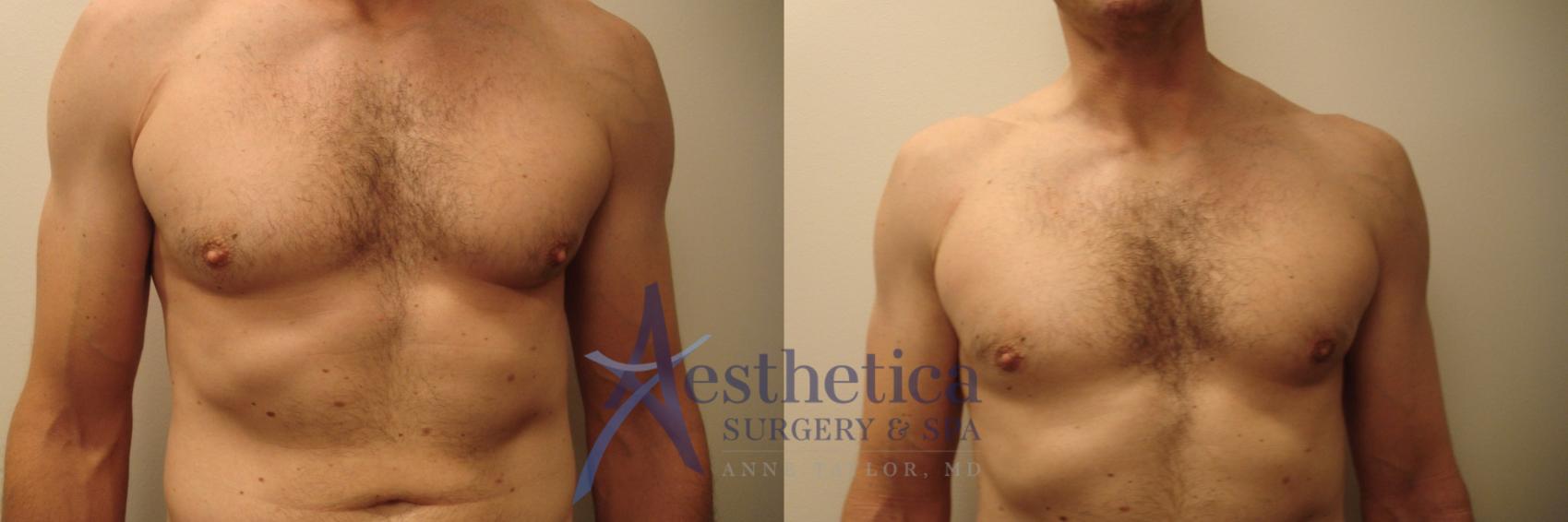 Gynecomastia Case 669 Before & After Front | Columbus, OH | Aesthetica Surgery & Spa