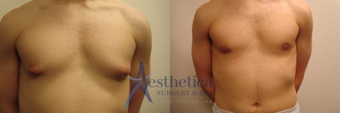 Gynecomastia Case 708 Before & After Front | Columbus, OH | Aesthetica Surgery & Spa