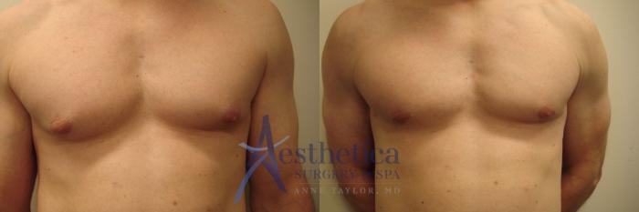 Gynecomastia Case 756 Before & After Front | Columbus, OH | Aesthetica Surgery & Spa