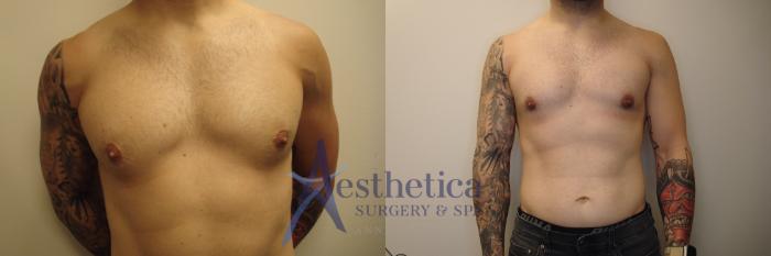 Gynecomastia Case 761 Before & After Front | Columbus, OH | Aesthetica Surgery & Spa