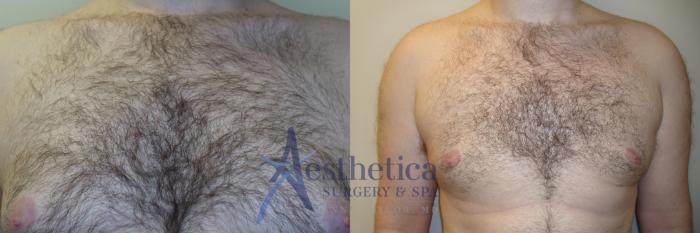 Gynecomastia Case 775 Before & After Front | Columbus, OH | Aesthetica Surgery & Spa