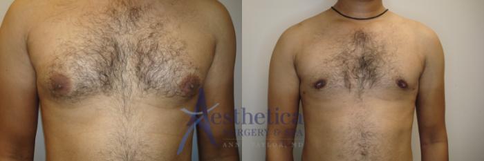 Gynecomastia Case 787 Before & After Front | Columbus, OH | Aesthetica Surgery & Spa