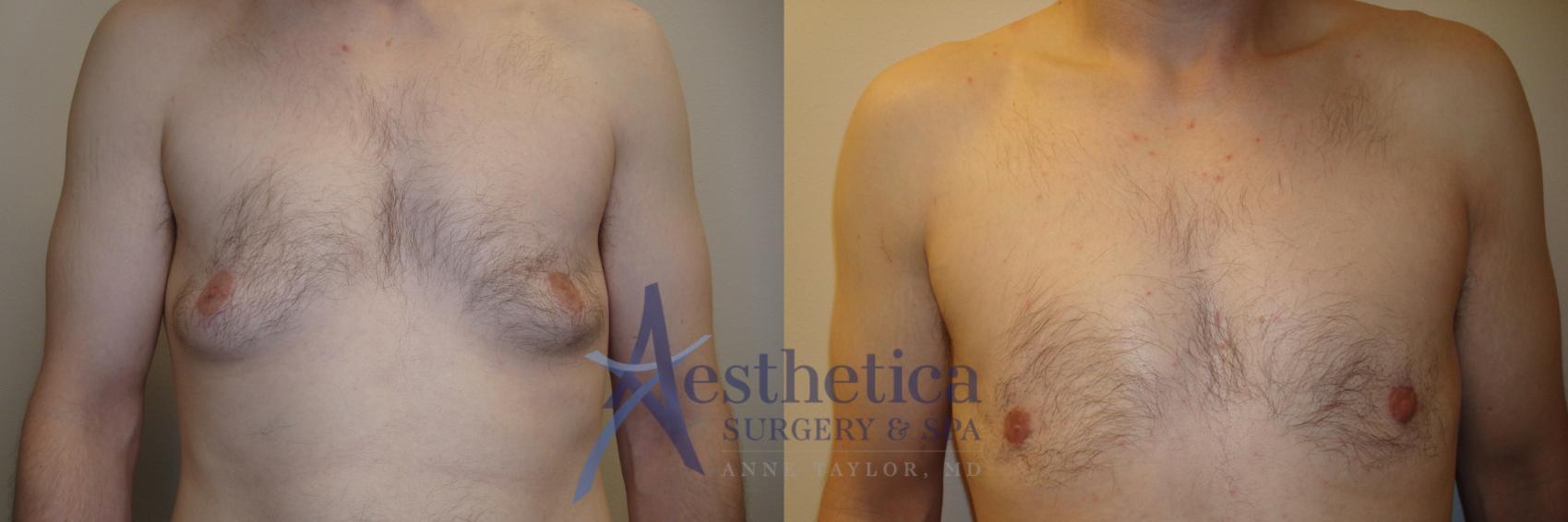 Gynecomastia Case 802 Before & After Front | Columbus, OH | Aesthetica Surgery & Spa