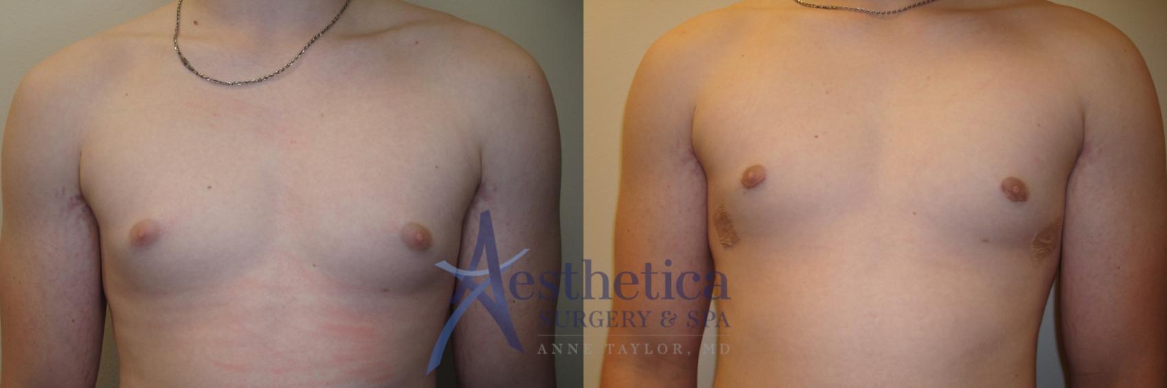 Gynecomastia Case 809 Before & After Front | Columbus, OH | Aesthetica Surgery & Spa