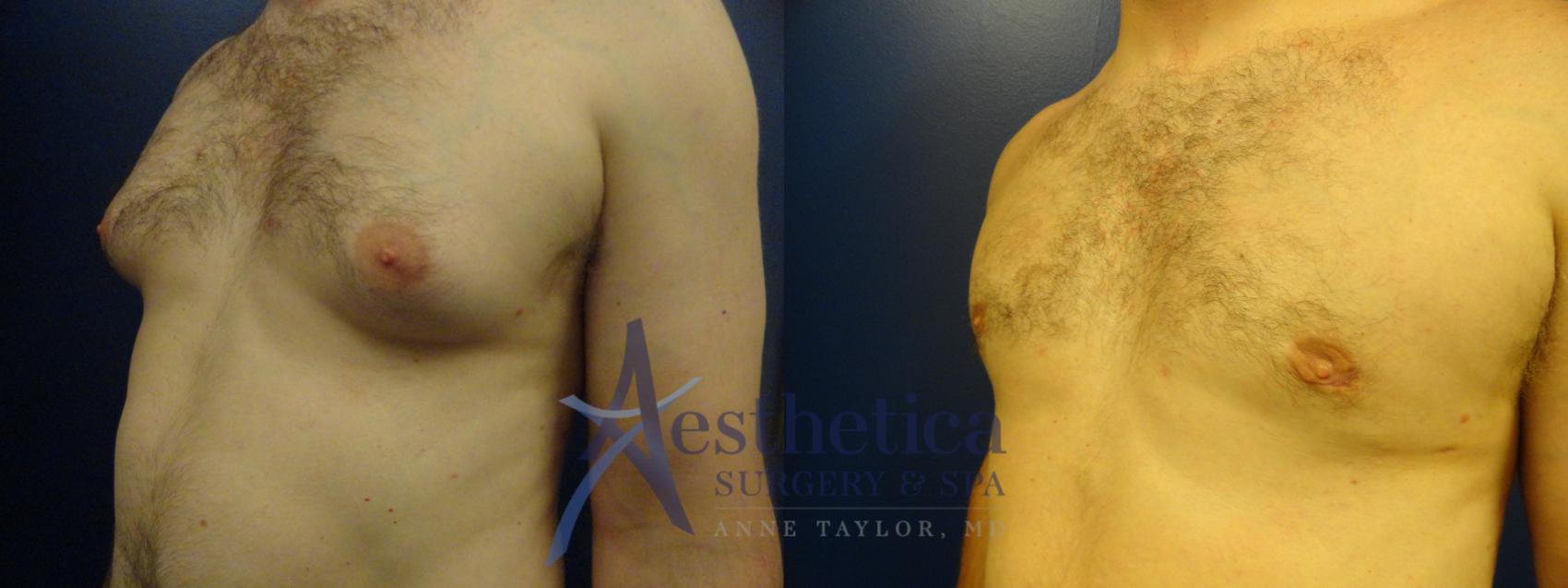 Gynecomastia Case 81 Before & After View #1 | Worthington, OH | Aesthetica Surgery & Spa