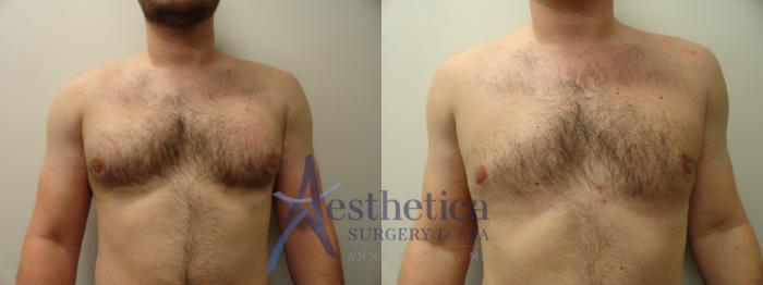 Gynecomastia Case 827 Before & After Front | Columbus, OH | Aesthetica Surgery & Spa