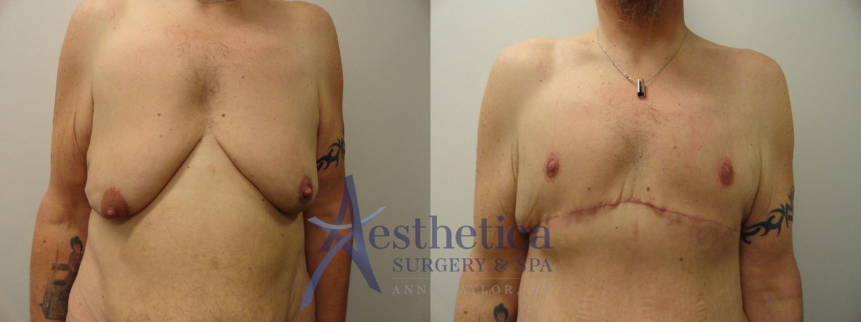 Gynecomastia Case 854 Before & After Front | Columbus, OH | Aesthetica Surgery & Spa