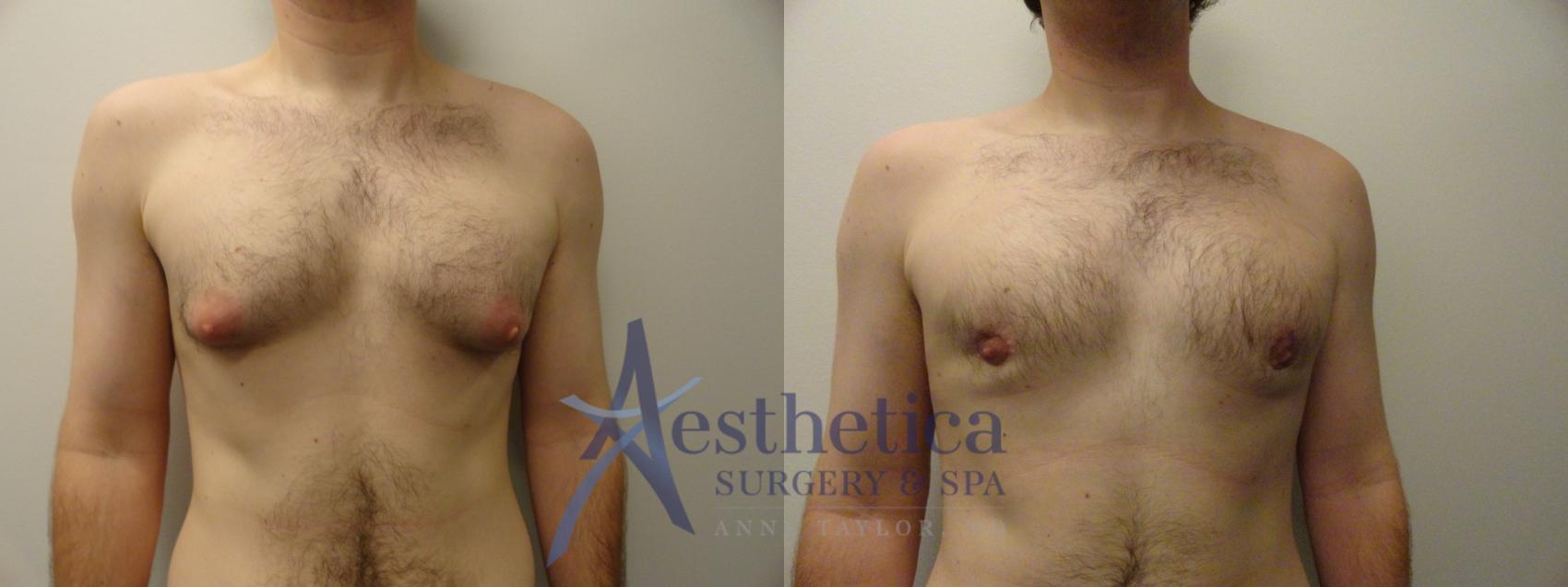 Gynecomastia Case 862 Before & After Front | Columbus, OH | Aesthetica Surgery & Spa
