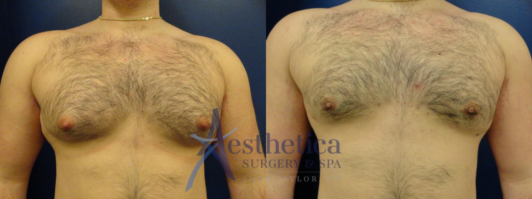 Gynecomastia Case 88 Before & After View #1 | Columbus, OH | Aesthetica Surgery & Spa